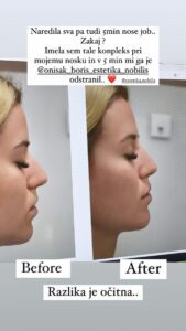 FOTO: Tjaša iz Sanjskega moškega se je odločila za estetski popravek