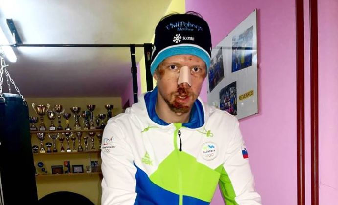 FOTO: To je prva fotografija Klemna Kosija po hudem padcu v Italiji
