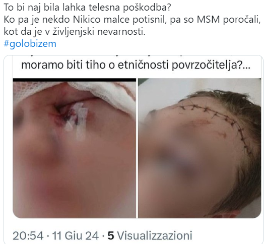 Incident na OŠ Velika Dolina: Nasprotja glede resnosti poškodb