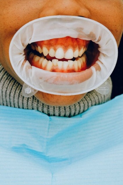 Implantat deluje kot naraven zob.