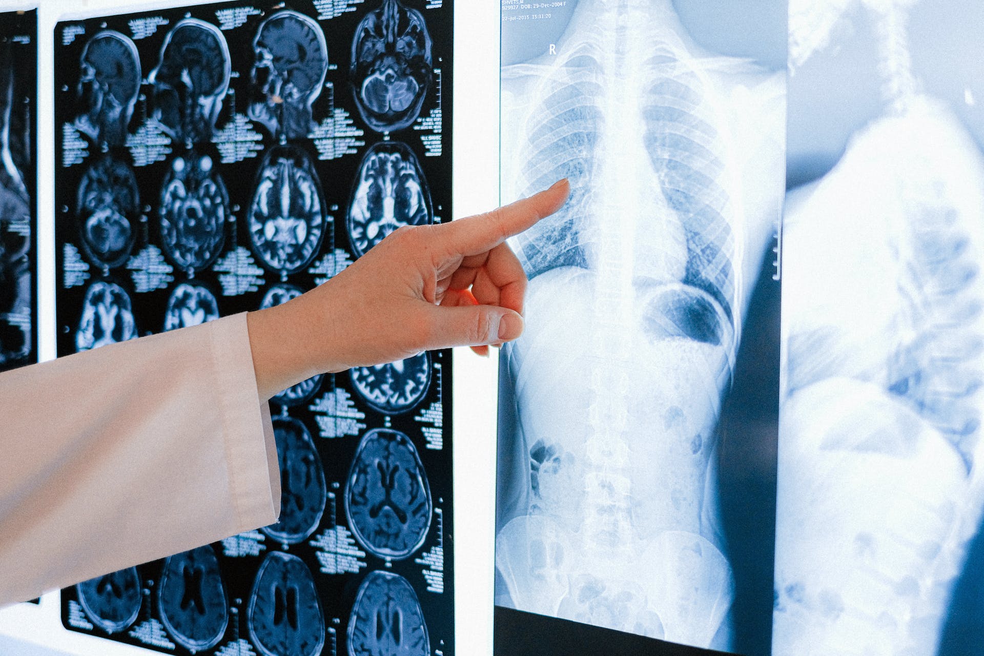 Pljučna embolija: diagnoza in zdravljenje