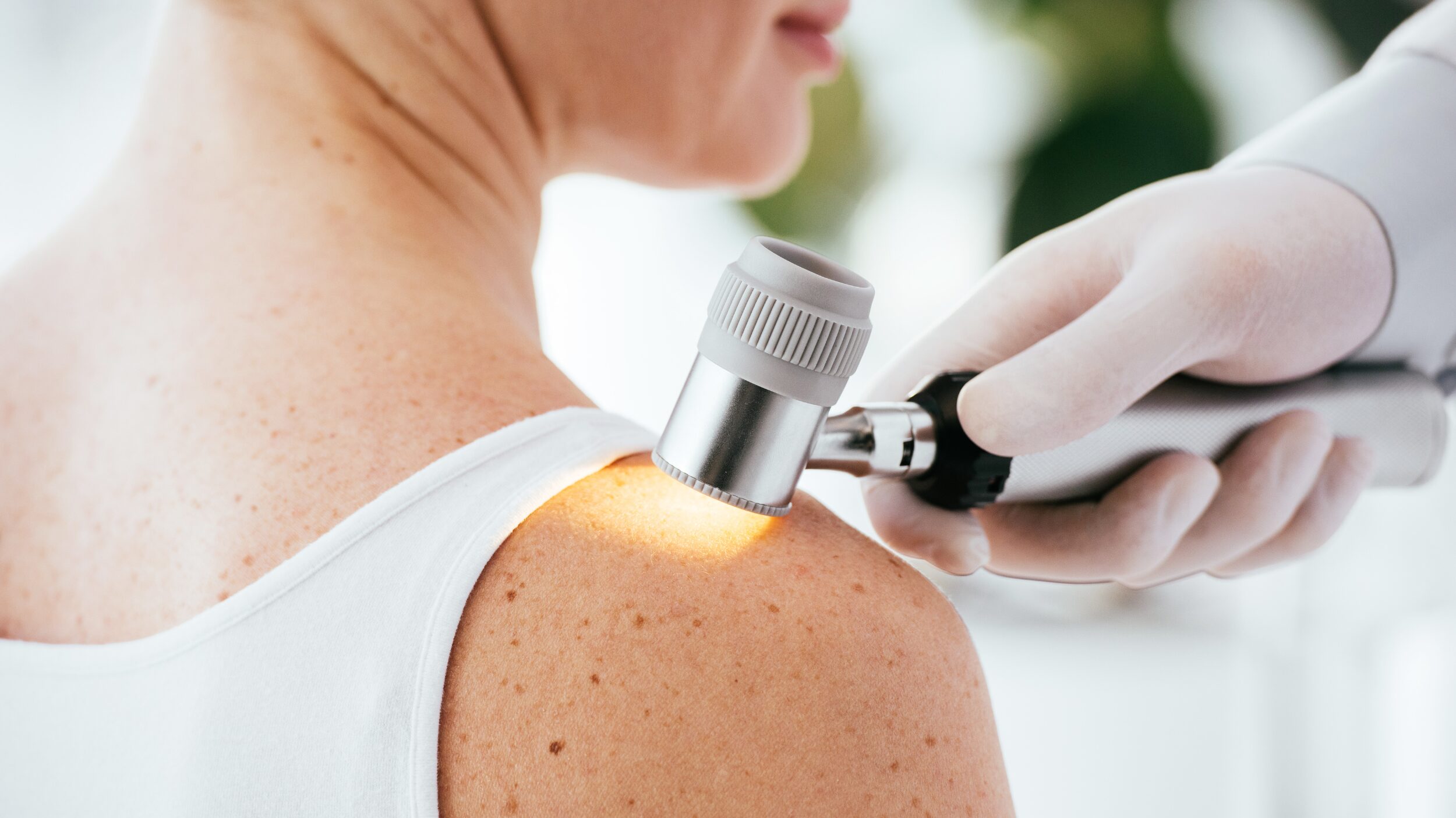 Melanom – najnevarnejši rak kože, ki ga ne smemo spregledati - NaDlani.si