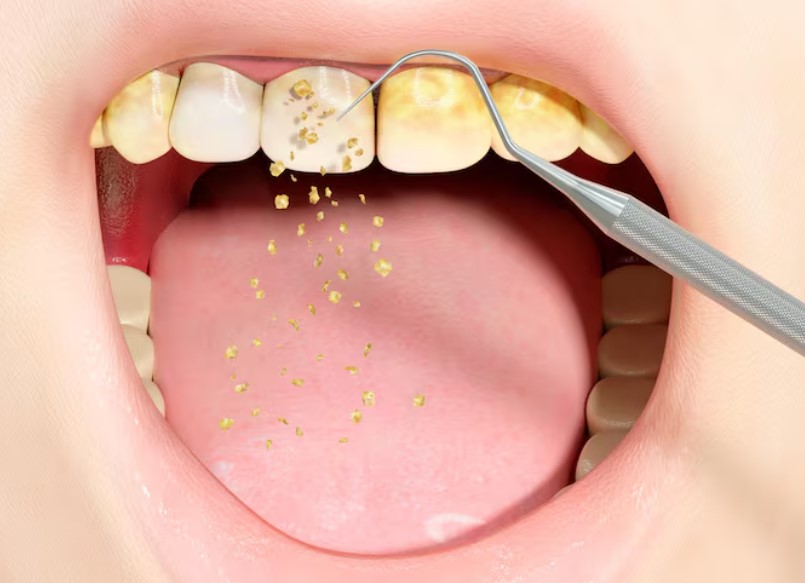 Zobni kamen, pomemben dejavnik bolezni Parodontoza