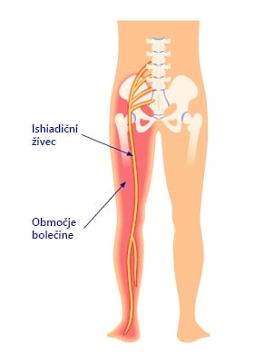vnetje živca v križu in širjenje bolečine v nogo