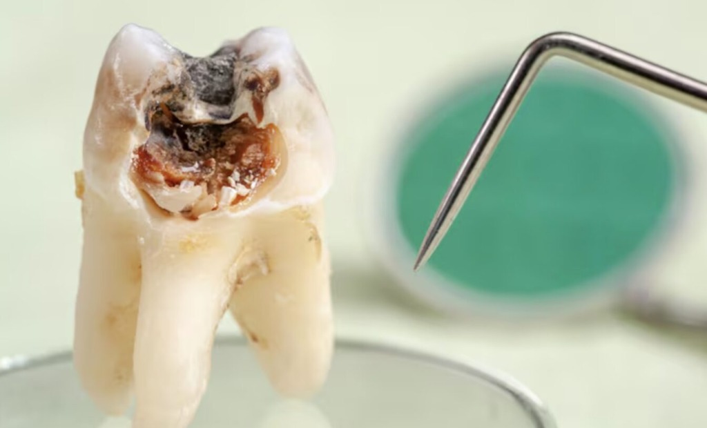 zobni-mosticek-karies - NaDlani.si