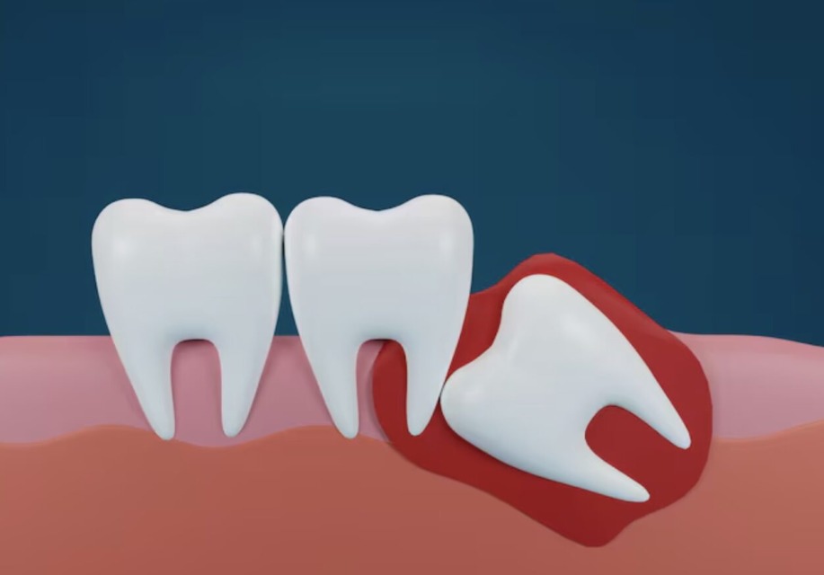 Modrostni zob: kaj se res dogaja, ko začne “nagajati”, in kako ukrepati pametno