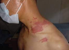 Zagotovo ste ga že kdaj v življenju opazili. Ta majhen hrošček lahko na koži pusti boleče opekline (FOTO)