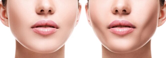 Je odstranitev maščobe v licih le nevarna modna muha? Spoznajte resnico o buccal fat removal in zakaj strokovnjaki svarijo pred nepovratnim staranjem obraza.