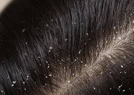 Tudi vas muči nadležen prhljaj? Tako si lahko pomagate hitro in učinkovito