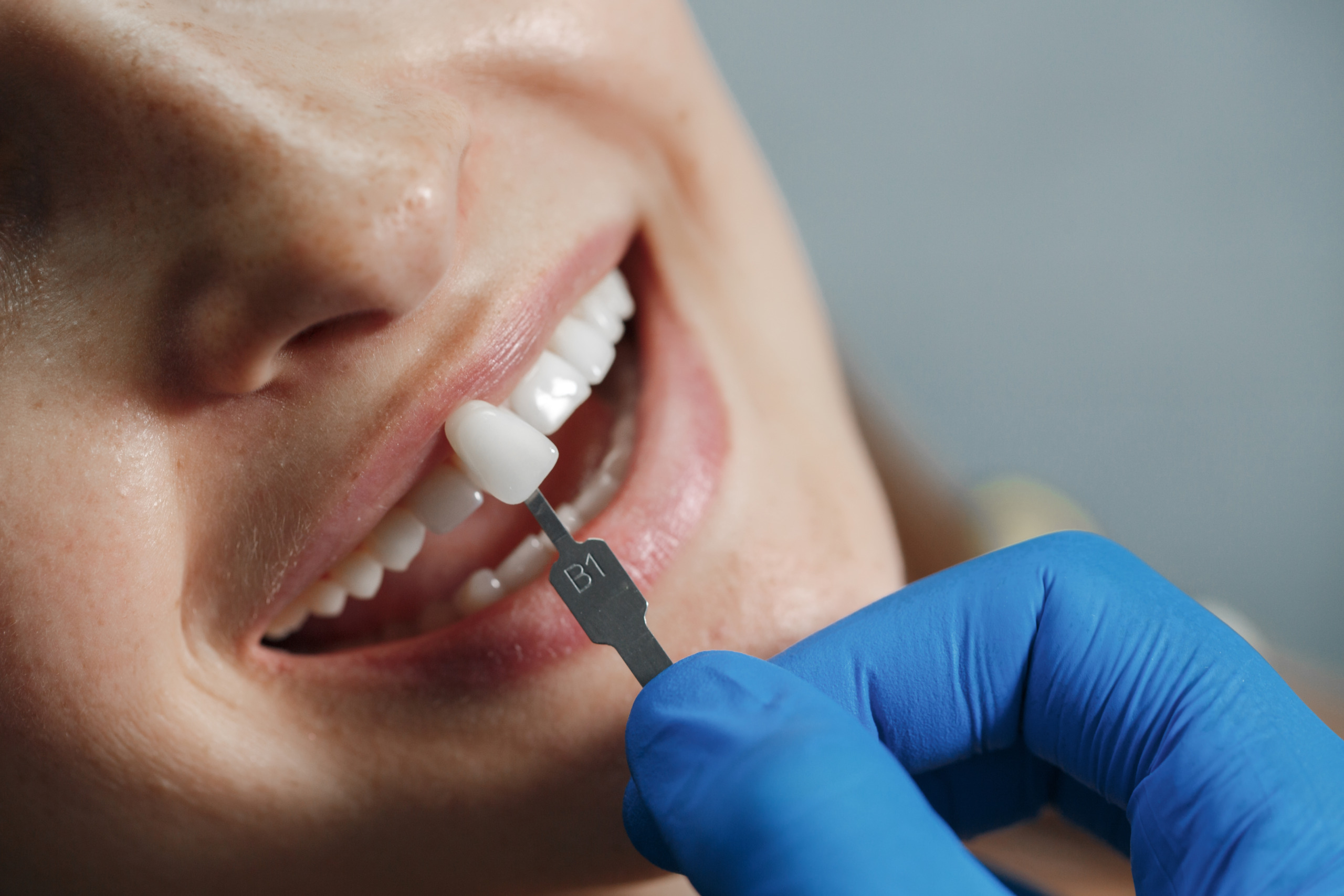 Ko zob poči ali potemni: kdaj je zobna prevleka najbolj pametna rešitev