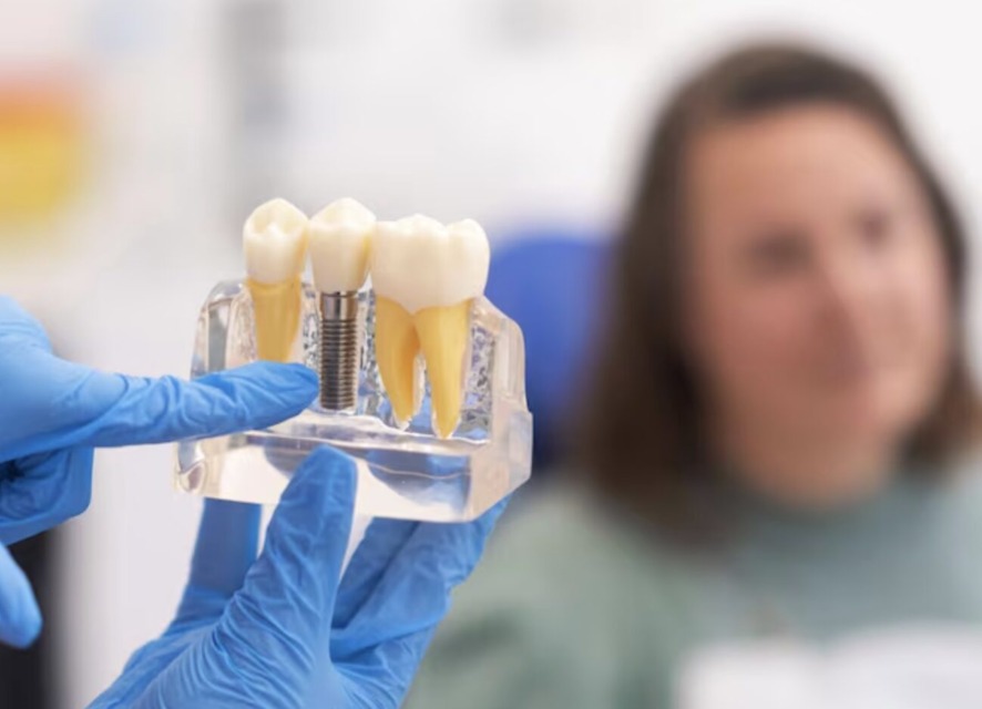 Zobni implantati, plastični model
