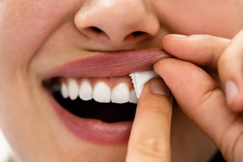 Close-up of a person peeling a whitening strip from their upper teeth while smiling.