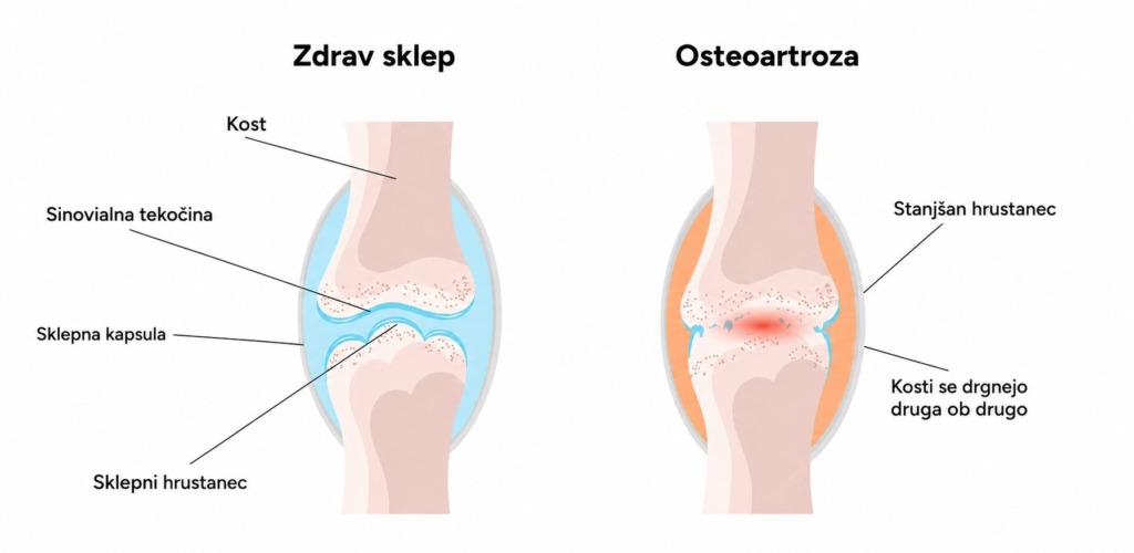 Bolečina v kolenu, ki jo povzroča osteoartoza