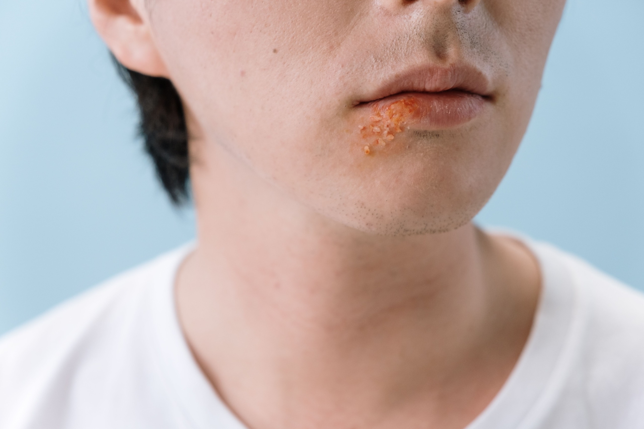 Herpes na ustnici
