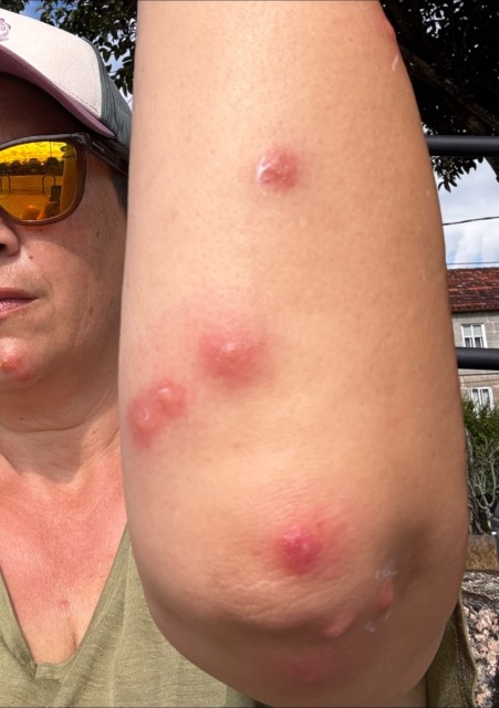 Slovenka po Caminu doživela pravo nočno moro: »Srbelo je za znoret, pojavili so se tudi mehurji«