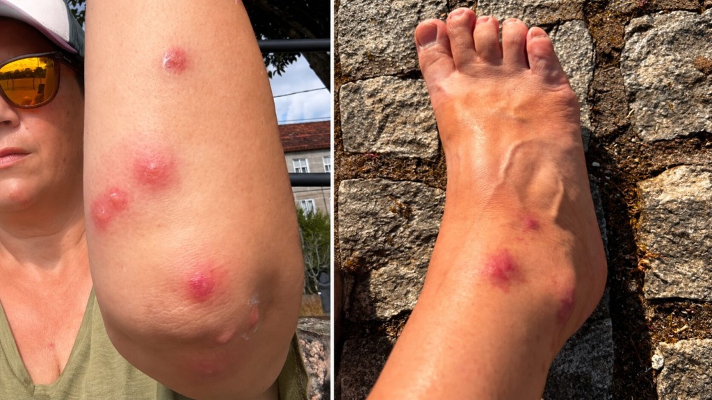 Slovenka po Caminu doživela pravo nočno moro: »Srbelo je za znoret, pojavili so se tudi mehurji«
