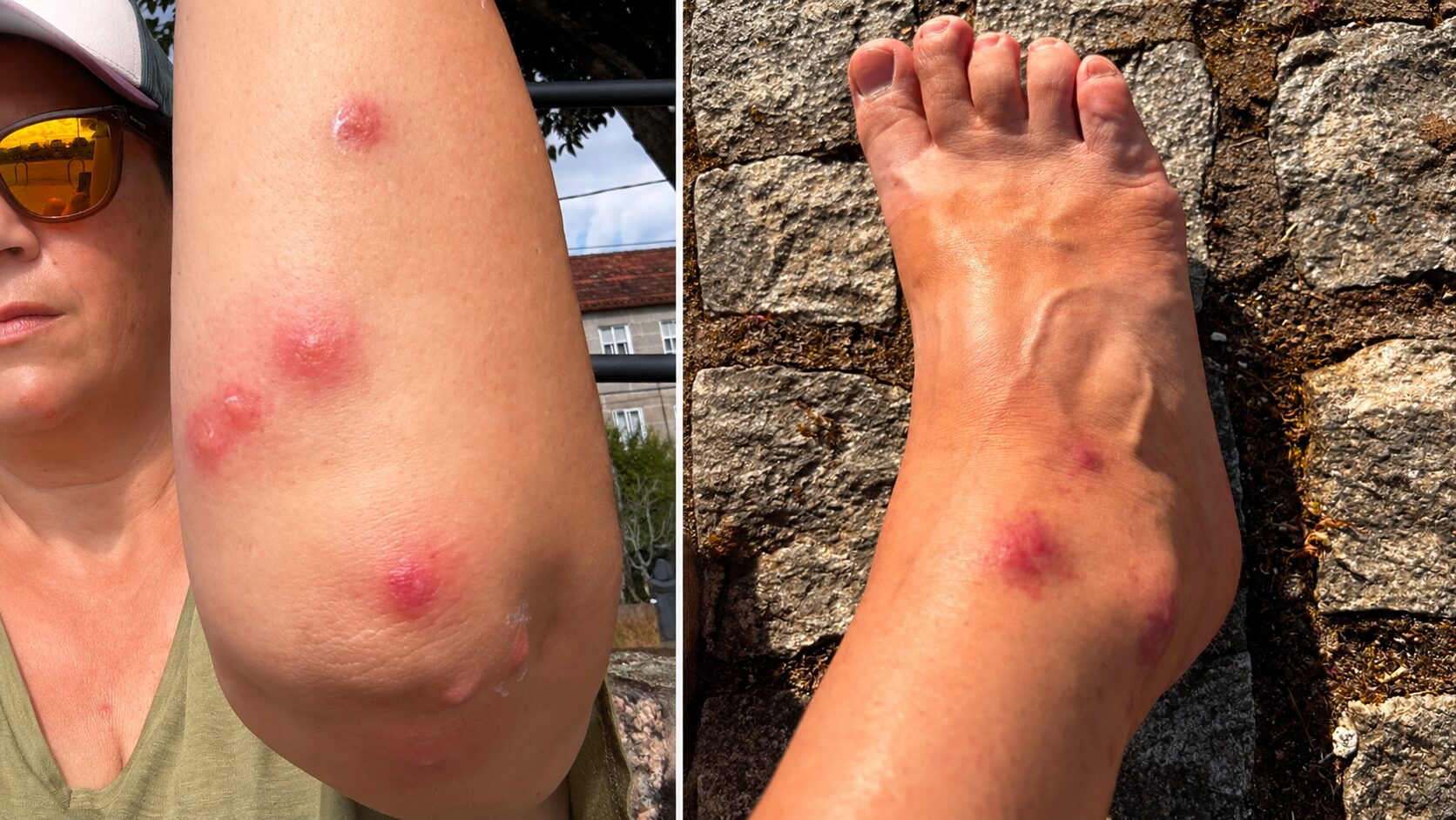 Slovenka po Caminu doživela pravo nočno moro: »Srbelo je za znoret, pojavili so se tudi mehurji«